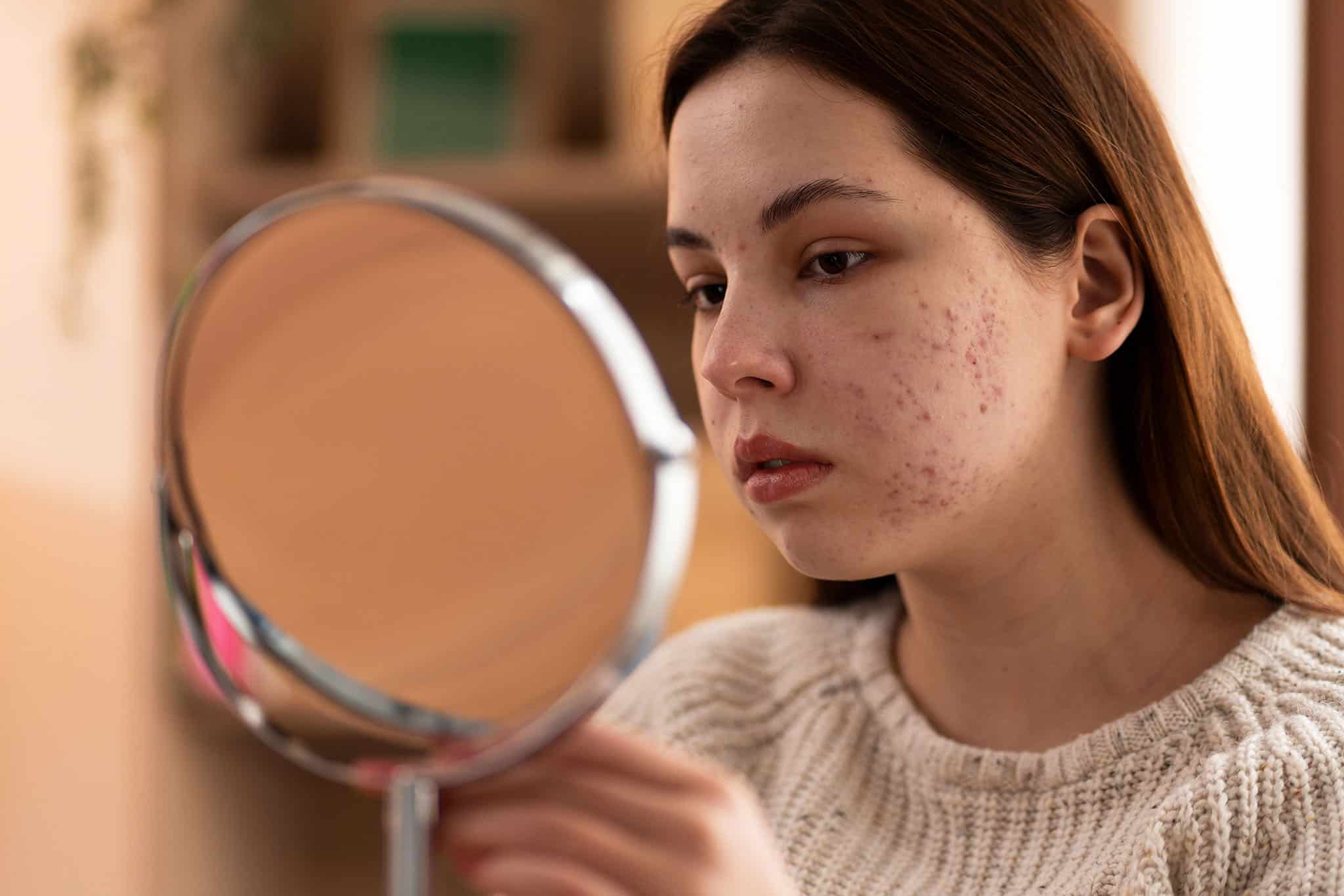The Best Cleansers for Tackling Acne